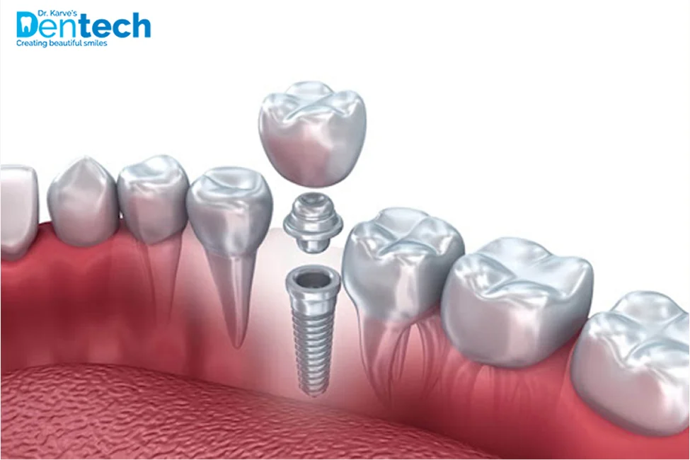 Dental Implants vs Bridges Finding What's Best for You